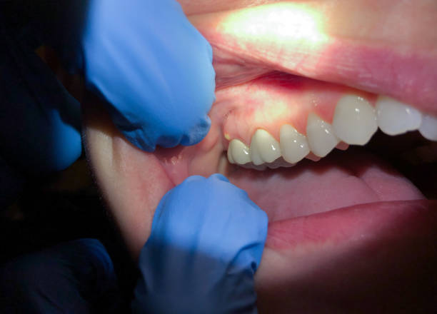 Best Emergency Tooth Extraction in Whitefish, MT